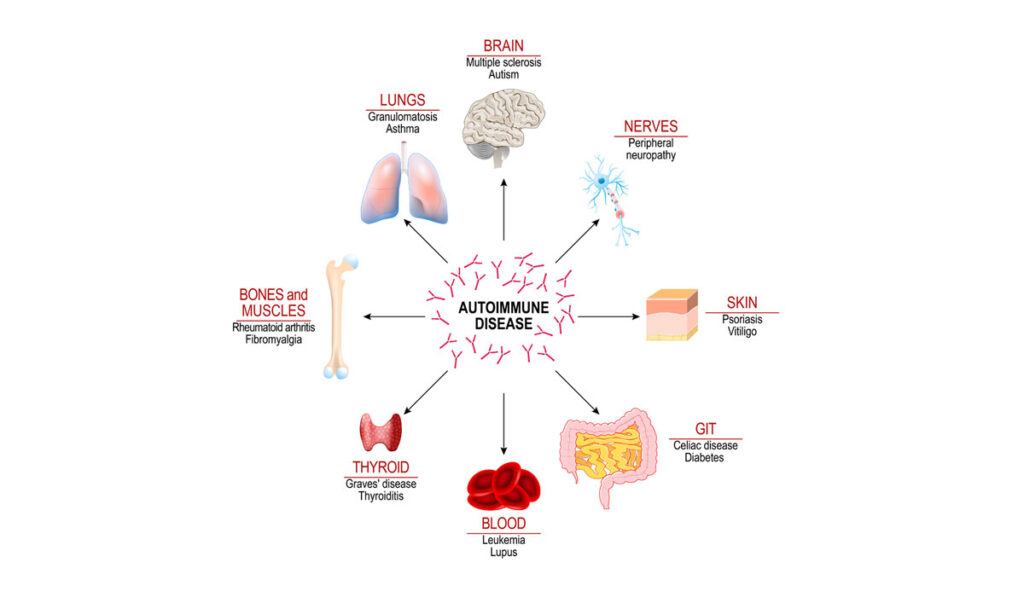 Autoimmune Disease